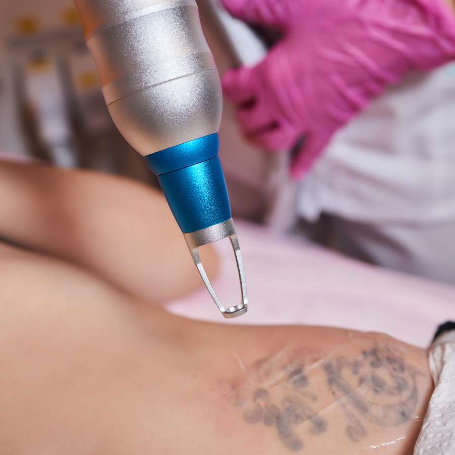 Tattoo Removal