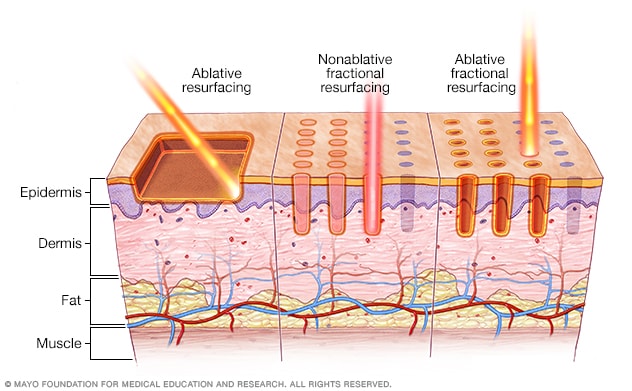 Exploring the World of Lasers - Types, Treatments, and Advances in Hair Removal and Skin Rejuvenation