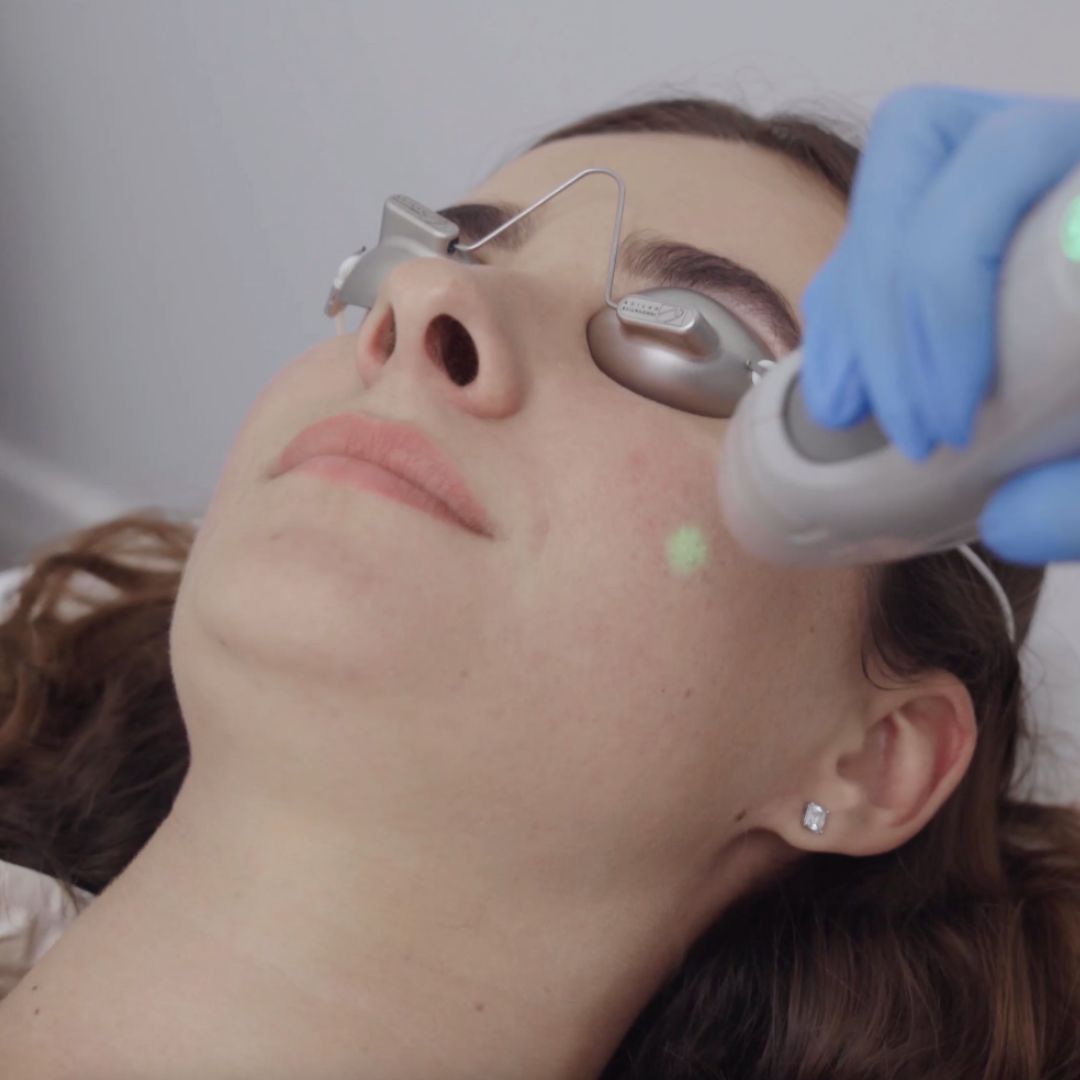 Reclaiming Your Smoothness - Laser Treatment for Chin Hair