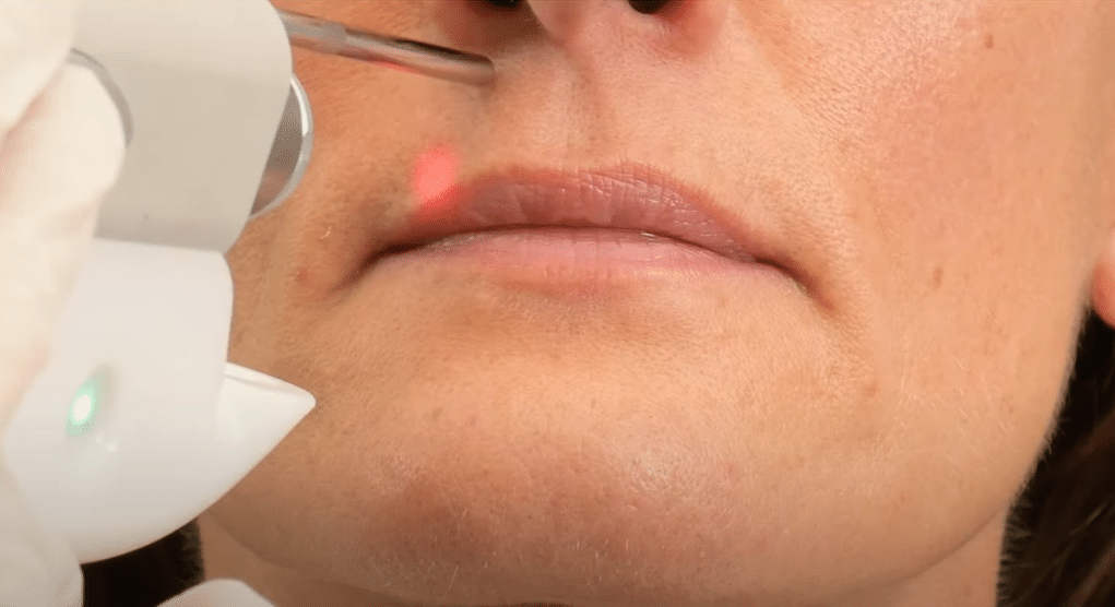 Reclaiming Your Smoothness - Laser Treatment for Chin Hair