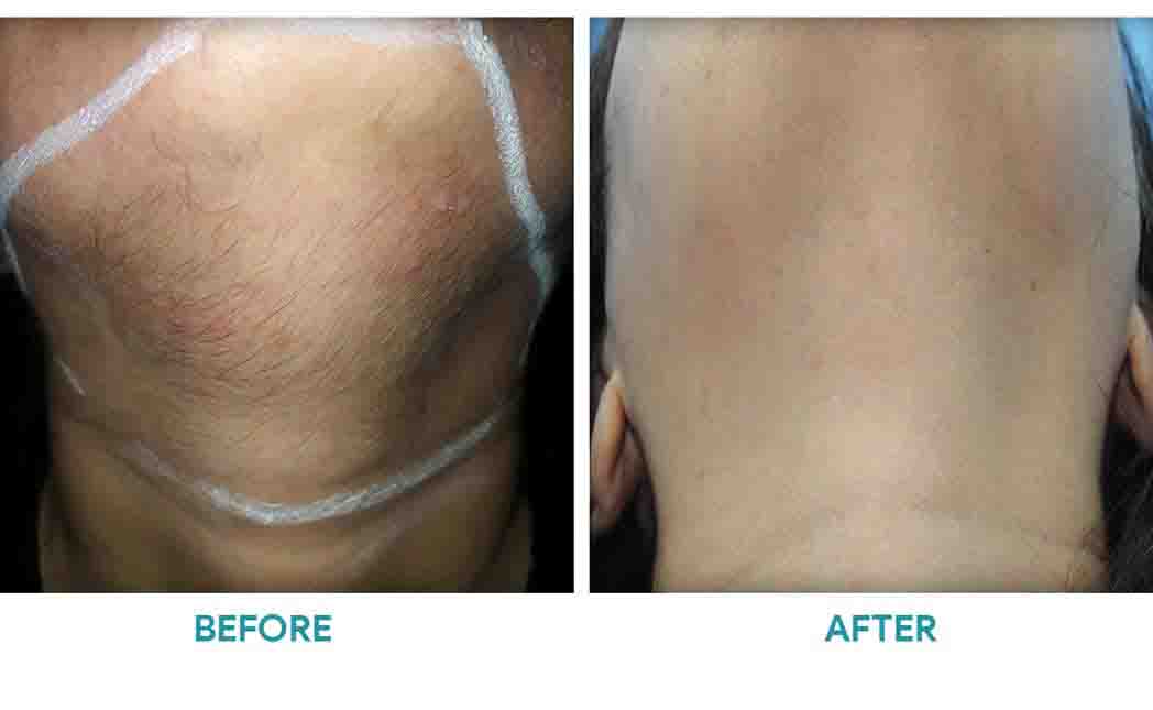 Unlocking Flawless Skin - Laser Treatment for Face Hair Removal Guide